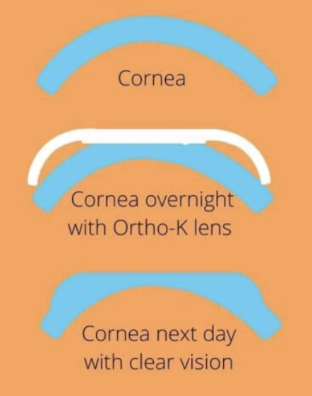 Myopia Management