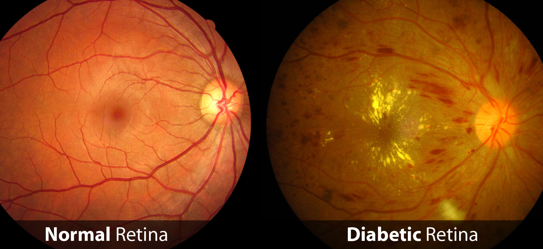 Diabetic-Retina