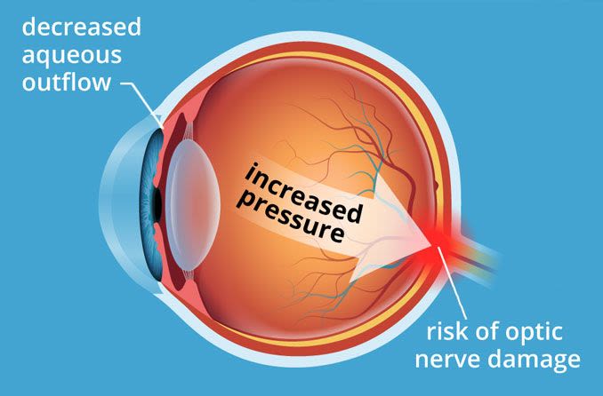 Hero_Article_ocular-hypertension-compressor