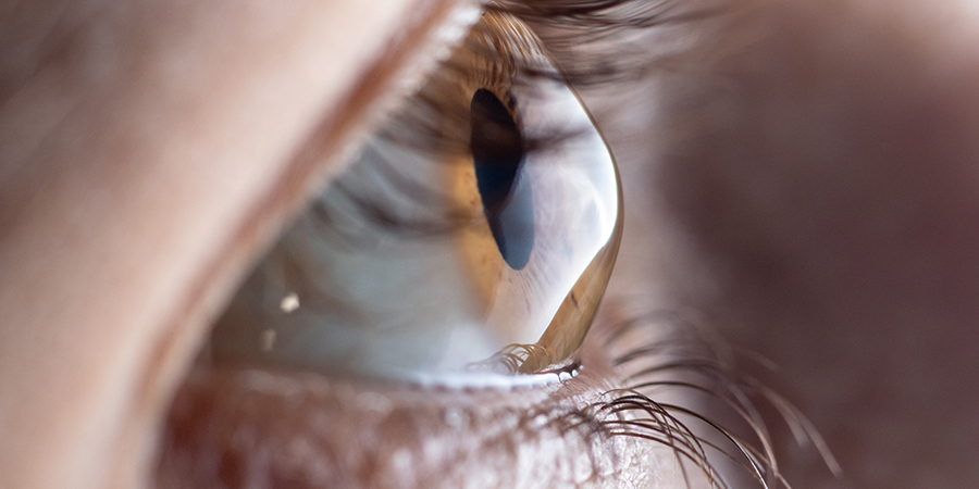 Macro eye photo. Keratoconus - eye disease, thinning of the cornea in the form of a cone. The cornea plastic